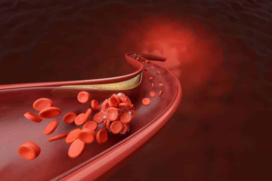 Chest Pain vs. Blood Clots